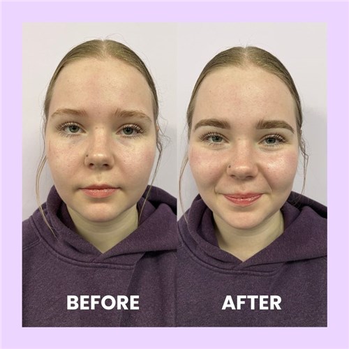 kenz before and after